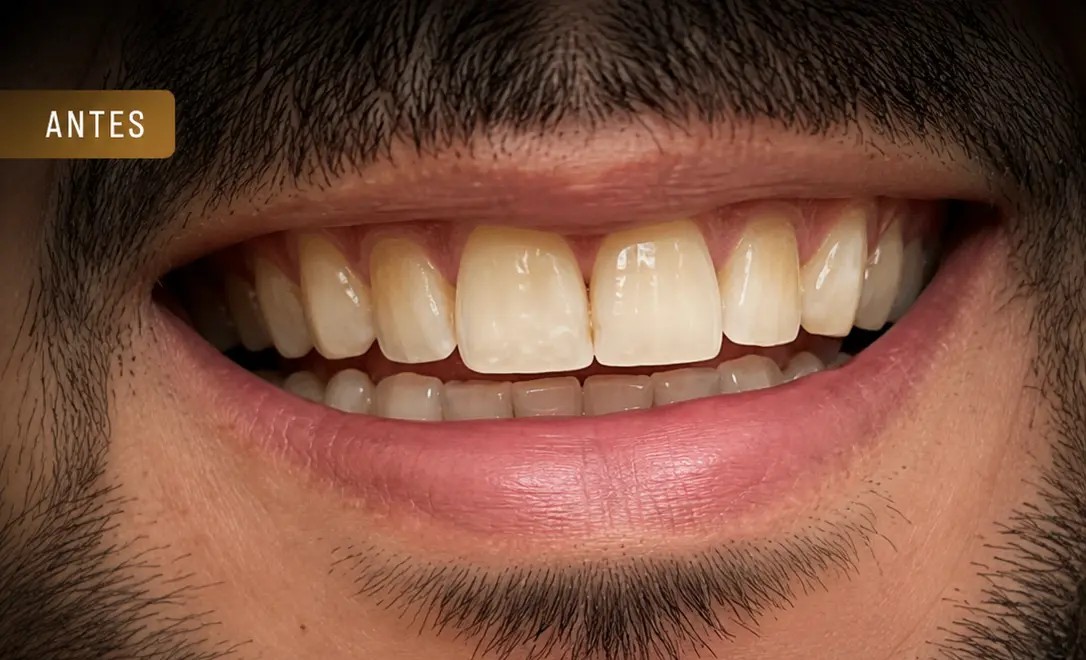 Antes — Lentes de contato dental