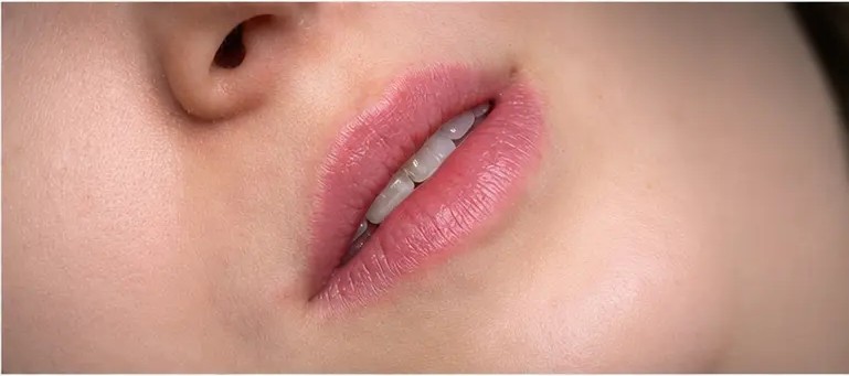 Depois — Preenchimento labial