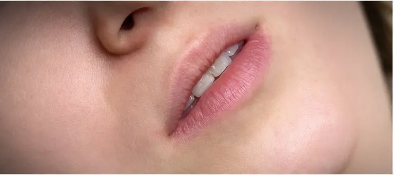 Antes — Preenchimento labial